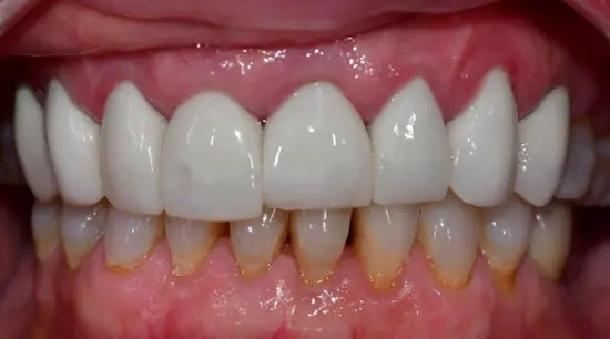 Before cosmetic dental treatment showing the patient's smile prior to treatment.