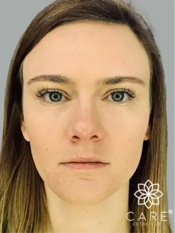 Woman's face after facial esthetics treatment at Plantation dental practice.