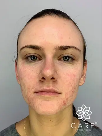 Patient before facial esthetics treatment at Plantation dental practice.