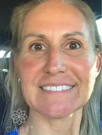 Smiling woman showing improved facial esthetics and bright teeth after cosmetic dental treatment.