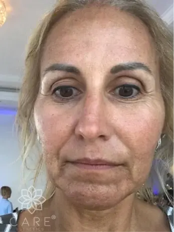 Woman before facial esthetics treatment at Plantation dental practice.