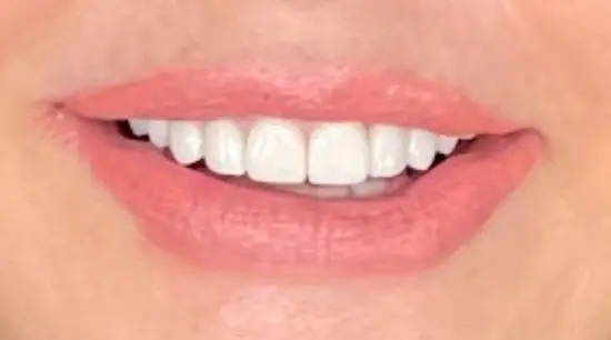After cosmetic dental treatment showing the patient's restored and enhanced smile.