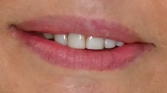 Before cosmetic dental treatment showing the patient's smile prior to treatment.