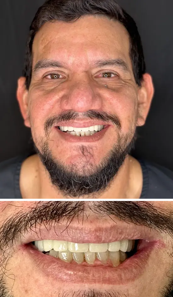 After cosmetic dental treatment showing the patient's restored and enhanced smile.