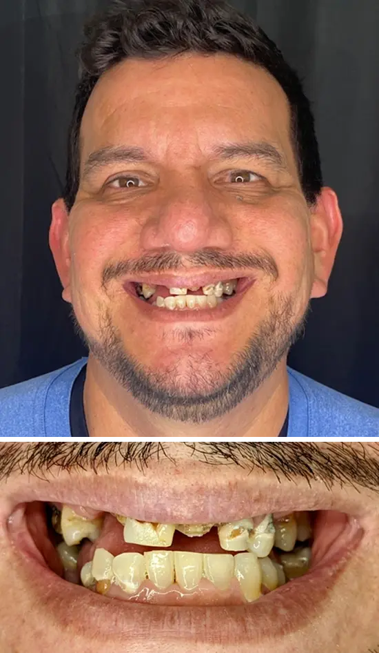 Before cosmetic dental treatment showing the patient's smile prior to treatment.
