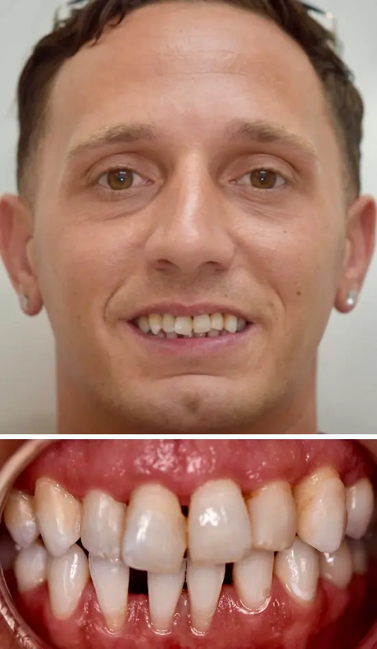Before cosmetic dental treatment showing the patient's smile prior to treatment.