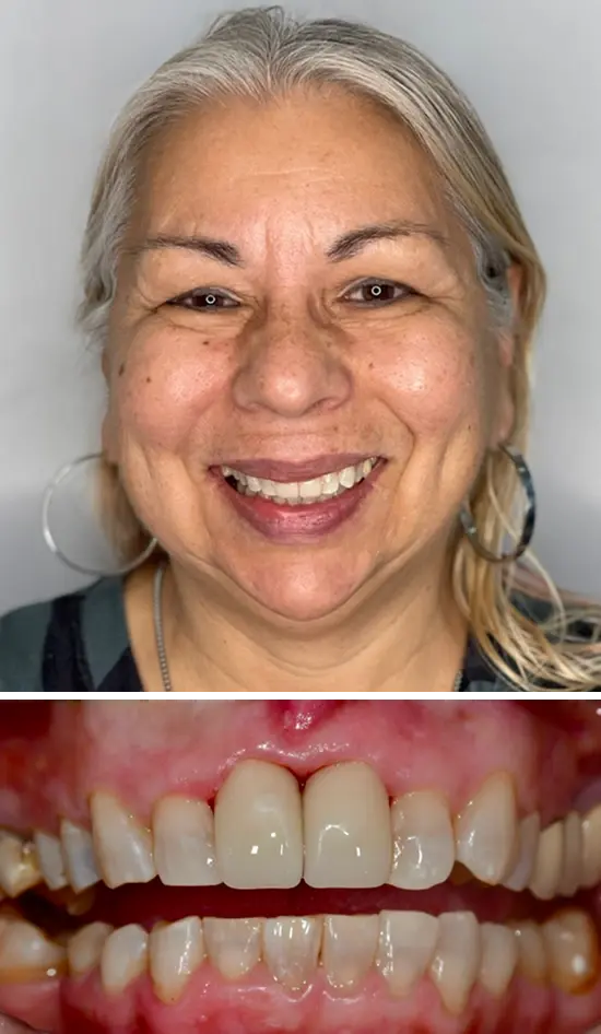 After cosmetic dental treatment showing the patient's restored and enhanced smile.