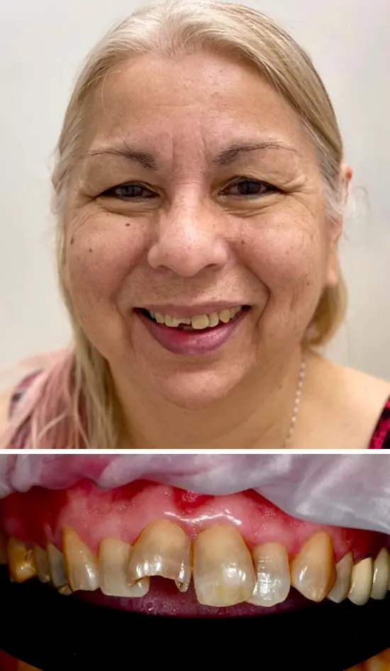 Before cosmetic dental treatment showing the patient's smile prior to treatment.