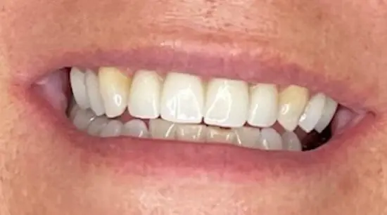 After cosmetic dental treatment showing the patient's restored and enhanced smile.
