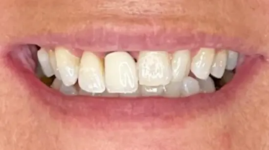 Before cosmetic dental treatment showing the patient's smile prior to treatment.