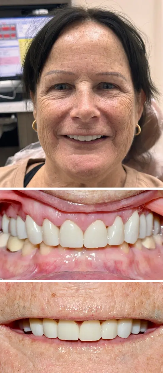 After cosmetic dental treatment showing the patient's restored and enhanced smile.