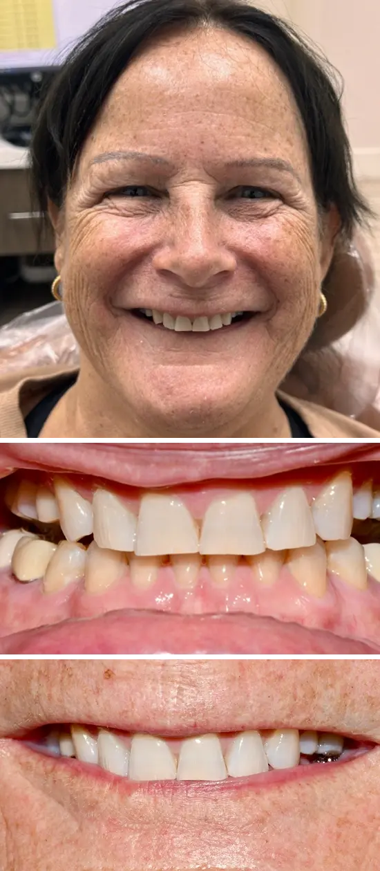 Before cosmetic dental treatment showing the patient's smile prior to treatment.