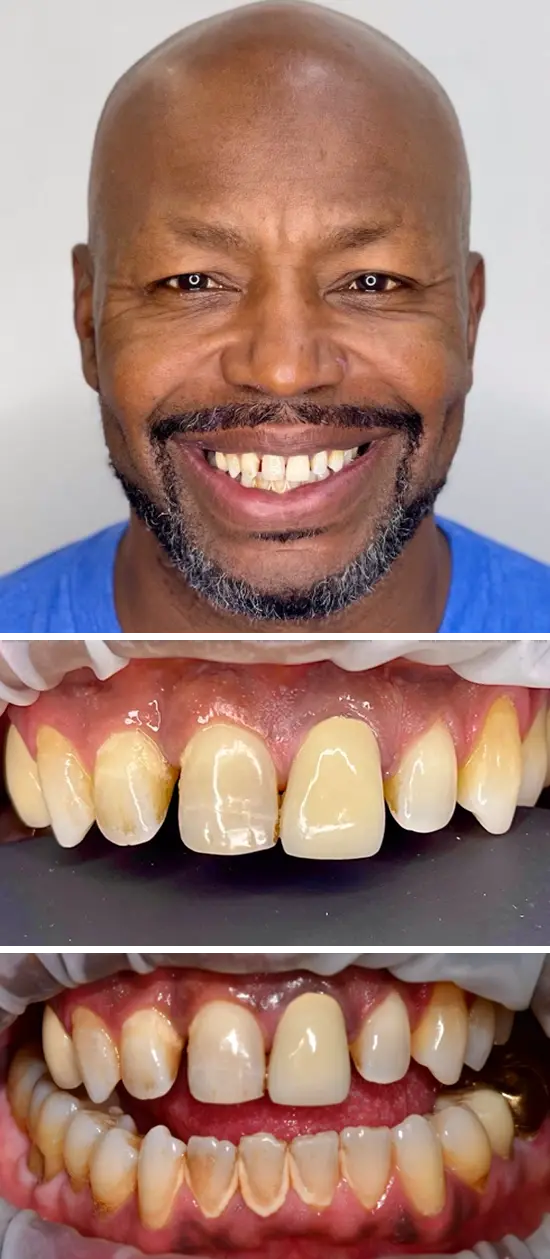 Before cosmetic dental treatment showing the patient's smile prior to treatment.