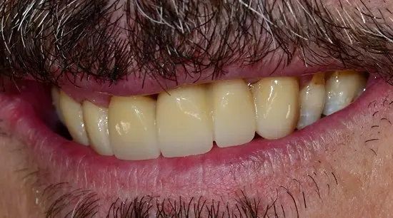 After cosmetic dental treatment showing the patient's restored and enhanced smile.