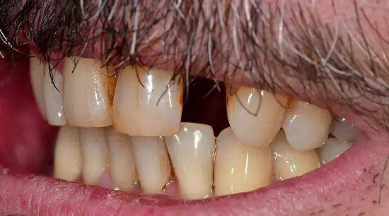 Before cosmetic dental treatment showing the patient's smile prior to treatment.