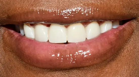 After cosmetic dental treatment showing the patient's restored and enhanced smile.