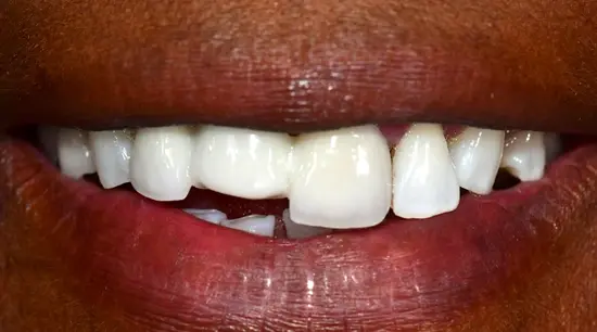 Before cosmetic dental treatment showing the patient's smile prior to treatment.