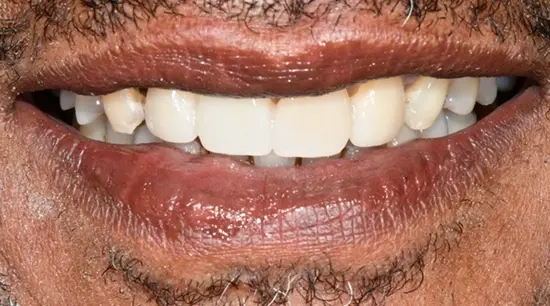 After cosmetic dental treatment showing the patient's restored and enhanced smile.