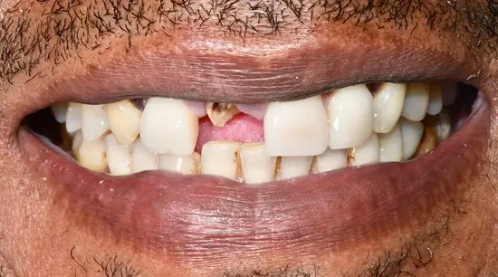 Before cosmetic dental treatment showing the patient's smile prior to treatment.