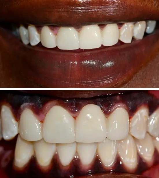 After cosmetic dental treatment showing the patient's restored and enhanced smile.