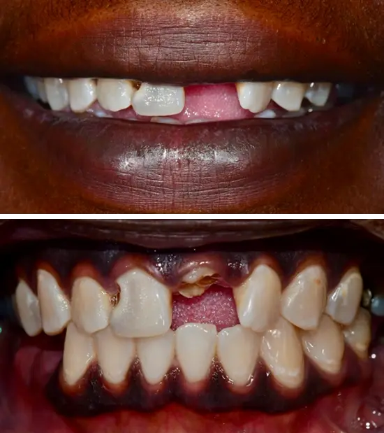 Before cosmetic dental treatment showing the patient's smile prior to treatment.