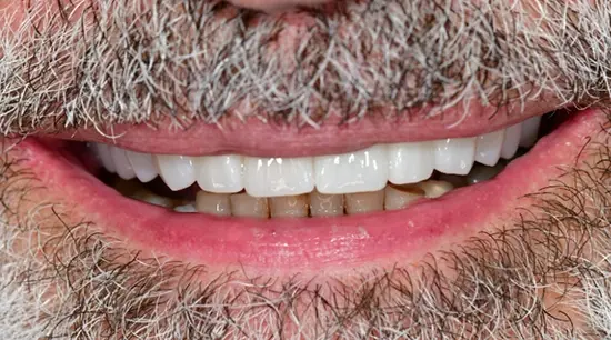After cosmetic dental treatment showing the patient's restored and enhanced smile.