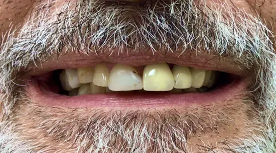 Before cosmetic dental treatment showing the patient's smile prior to treatment.
