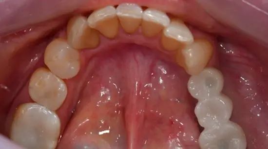 After cosmetic dental treatment showing the patient's restored and enhanced smile.