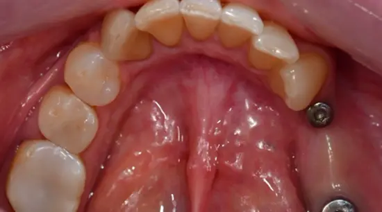 Before cosmetic dental treatment showing the patient's smile prior to treatment.