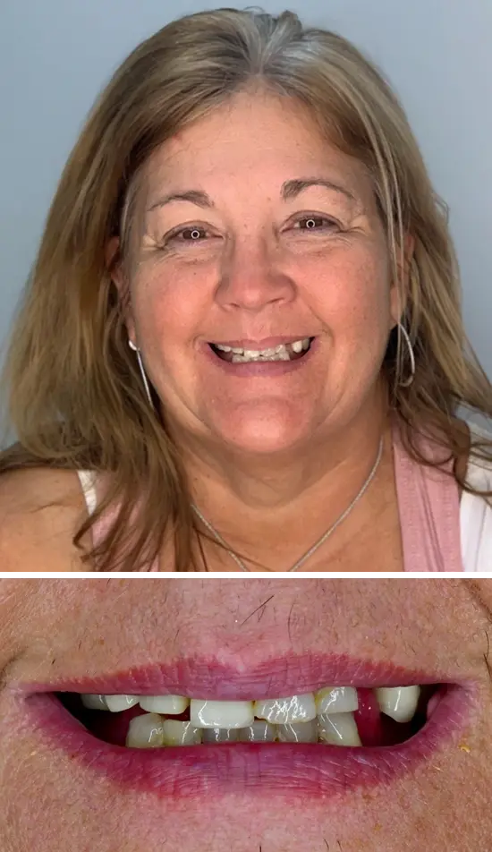 Before cosmetic dental treatment showing the patient's smile prior to treatment.