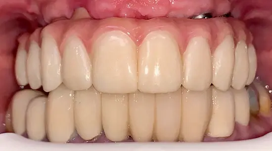 After cosmetic dental treatment showing the patient's restored and enhanced smile.