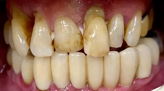 Before cosmetic dental treatment showing the patient's smile prior to treatment.