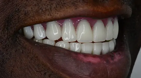 After cosmetic dental treatment showing the patient's restored and enhanced smile.