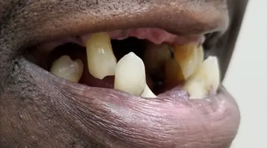 Before cosmetic dental treatment showing the patient's smile prior to treatment.