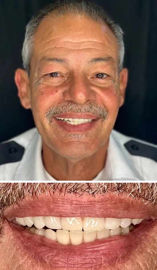 After cosmetic dental treatment showing the patient's restored and enhanced smile.