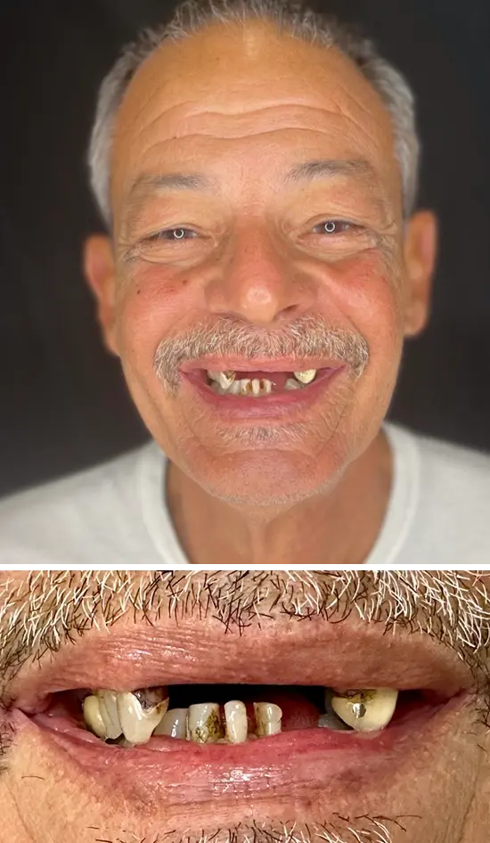 Before cosmetic dental treatment showing the patient's smile prior to treatment.