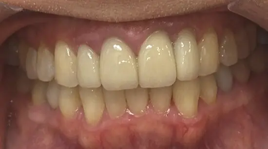 After cosmetic dental treatment showing the patient's restored and enhanced smile.