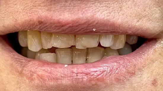 Before cosmetic dental treatment showing the patient's smile prior to treatment.