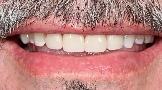 After cosmetic dental treatment showing the patient's restored and enhanced smile.