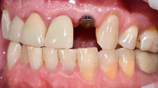 Before cosmetic dental treatment showing the patient's smile prior to treatment.