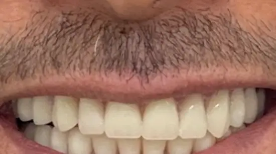 After cosmetic dental treatment showing the patient's restored and enhanced smile.