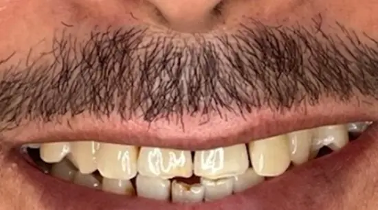 Before cosmetic dental treatment showing the patient's smile prior to treatment.