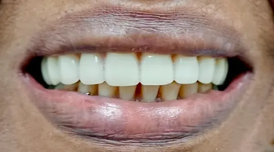 After cosmetic dental treatment showing the patient's restored and enhanced smile.