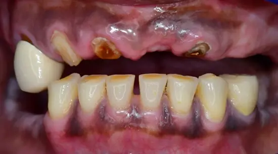 Before cosmetic dental treatment showing the patient's smile prior to treatment.