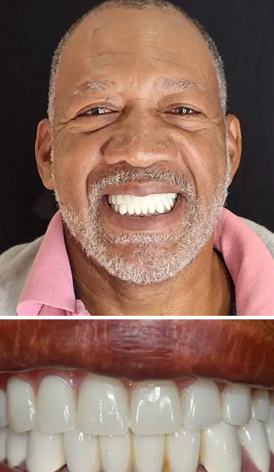 After cosmetic dental treatment showing the patient's restored and enhanced smile.