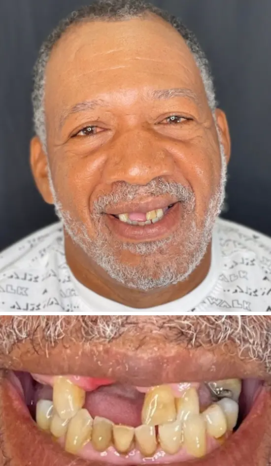Before cosmetic dental treatment showing the patient's smile prior to treatment.