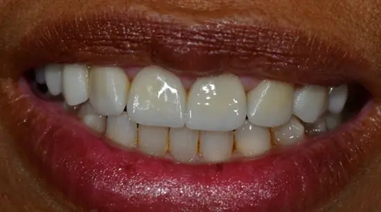 After cosmetic dental treatment showing the patient's restored and enhanced smile.