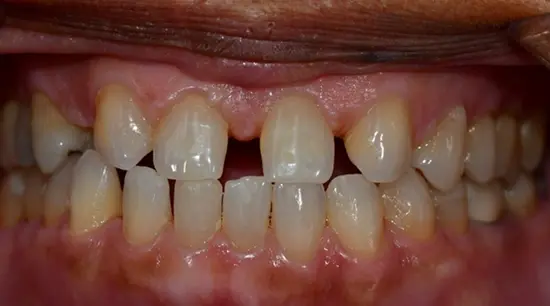 Before cosmetic dental treatment showing the patient's smile prior to treatment.