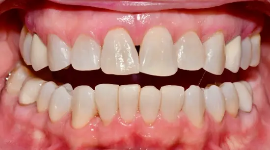After cosmetic dental treatment showing the patient's restored and enhanced smile.