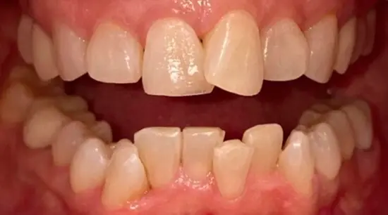 Before cosmetic dental treatment showing the patient's smile prior to treatment.